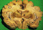   | Brain | 