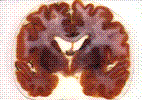   | Brain | 