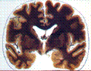   | Brain | 